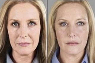 Radio Frequency Treatment 5 Before and After Radio Frequency Treatment