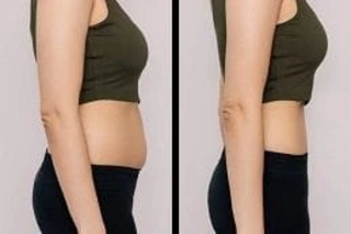 Slimming Treatments 4 Before and After Slimming Treatments