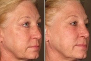 Ultherapy Treatment 3 Before and After Ultherapy in Dubai