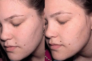 Derma Rollers Treatment Before & After