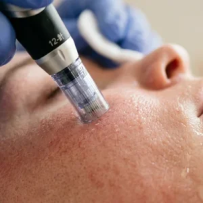 Dermapen Treatment in Dubai