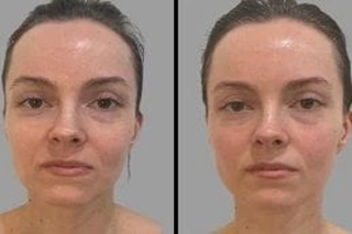 Derpamen Treatment Before & After