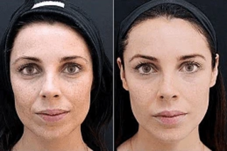 Fotona 4D For Face 5 Fotona 4D For Face After and Before