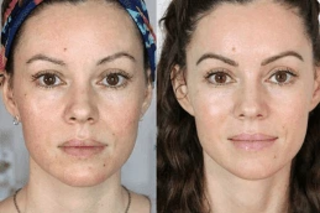 Fotona 4D For Face 6 Fotona 4D For Face Before and After
