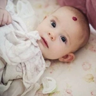 Hemangiomas Treatment in Dubai