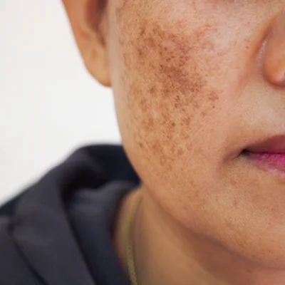 How to Treat Melasma on Face During Pregnancy