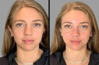 Hydrafacial Before & After