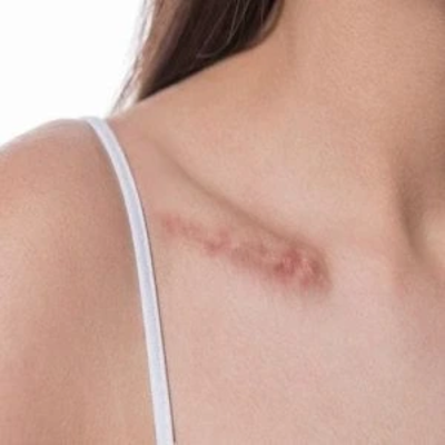 Hypertrophic Scars Treatment in Dubai