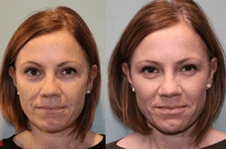 Laser Photo Rejuvenation 5 Laser Photo Rejuvenation Before & After