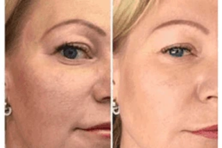 MESOGOLD Stamp Therapy Before & After