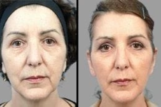 Microdermabrasion 5 Microdermabrasion Before & After