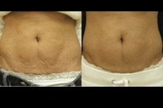 Proellixe Vibration Therapy 5 Proellixe VibrationTherapy Before & After