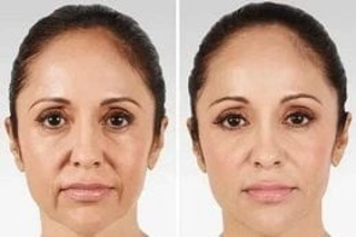 Profhilo Treatment Before & After