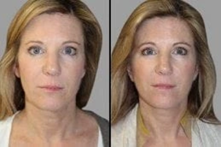 Radio Frequency Treatment 6 Radio Frequency Treatment Before and After