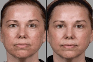 Red Carpet Facial Before & After