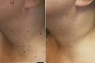 Skin Lesion Removal Treatment Before & After