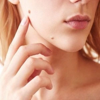 Skin Lesion Removal Treatment in Dubai