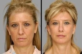 Skin Rejuvenation 6 Skin Rejuvenation Before & After