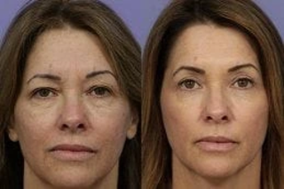 Laser Skin Resurfacing 4 Skin Resurfacing Before & After