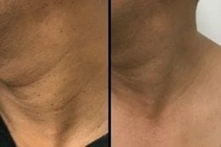 Skin Tag Removal 4 Skin Tag Removal Before & After