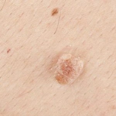 Skin Tag Removal in Dubai
