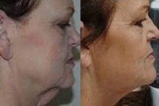 Skin Tightening and Contouring 5 Skin Tightening and Contouring Treatment Before & After