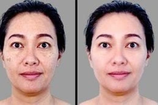 Skin Whitening Treatment Before & After