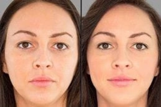 Spectra Laser Carbon Peel Before and After