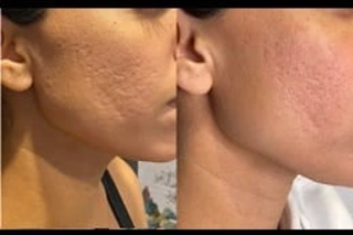 Subcision Treatment for Acne Scars Before & After