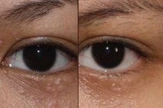 Syringoma Removal Treatment 4 Syringoma Removal Before & After