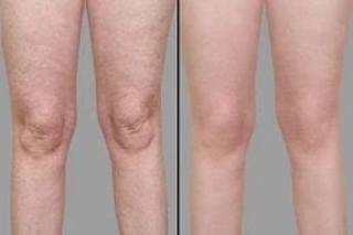 Velashape 3 Treatment Before & After