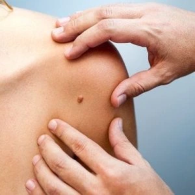 Wart Removal in Dubai