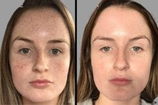 Cold Peel 4 Before & After Cold Peel in Dubai
