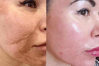 Before & After Cosmelan Peel Treatment in Dubai