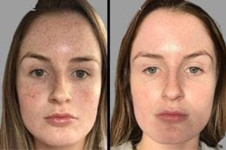 Before & After Dermamelan Treatment in Dubai