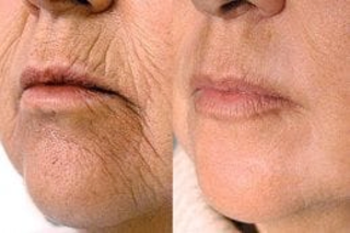 Erbium Peel | Erbium YAG Laser 4 Before & After Erbium peel in Dubai