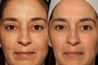 Erbium Peel | Erbium YAG Laser 5 Before & After Erbium peel