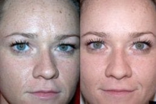 Glycolic Peel Treatment 4 Before & After Glycolic Acid Peel in Dubai