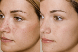 Glycolic Peel Treatment 6 Before & After Glycolic Acid Peel
