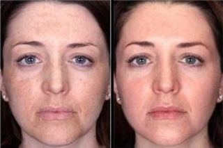 Before & After Green Peel Treatment in Dubai