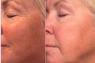 Before & After PCA Peel Treatment in Dubai