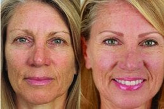 Semi Permanent Makeup 4 Before & After Semi Permanent Makeup Treatment in Dubai