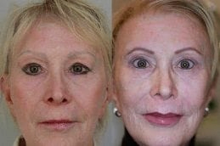 Semi Permanent Makeup 5 Before & After Semi Permanent Makeup Treatment