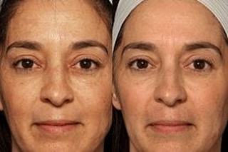 Erbium Peel | Erbium YAG Laser 6 Erbium peel Before & After