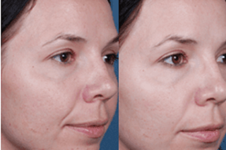 Glycolic Peel Treatment 5 Glycolic Acid Peel Before & After