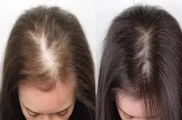 Mesotherapy for Hair Dubai before and after