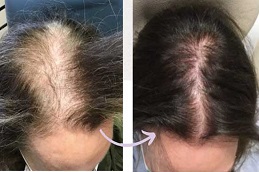 Mesotherapy for Hair in Dubai before and after