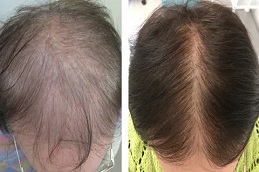 Mesotherapy for Hair 6 before and after Mesotherapy for Hair in Dubai