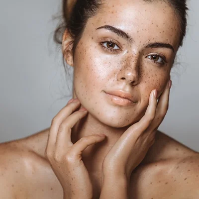 Best Melasma Treatment in Dubai