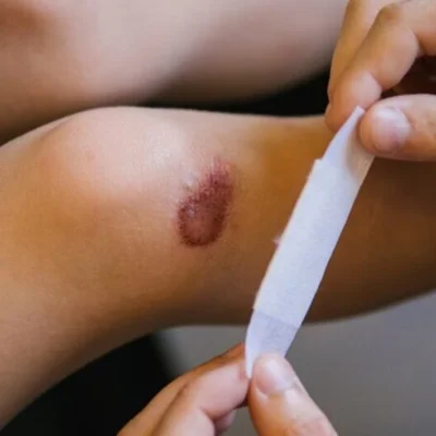 Chronic Wounds Treatment
